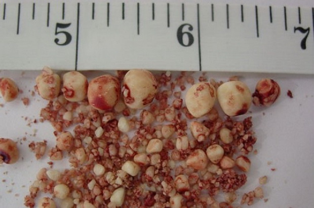 Böbreğinden 794 taş çıkarıldı 6 kamani v babretzite