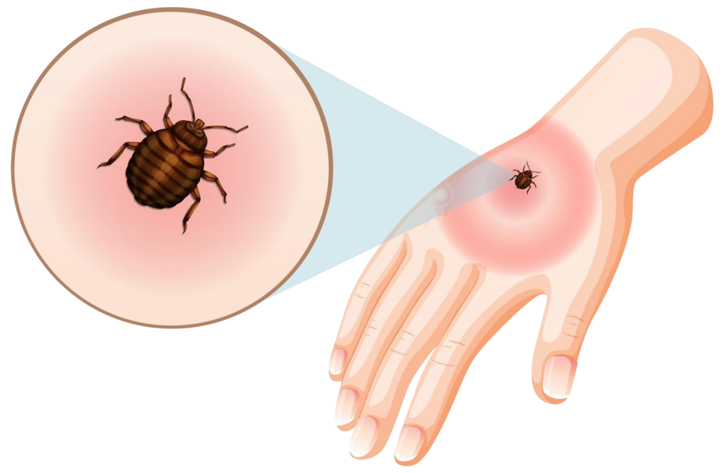 bed bug bites sting skin