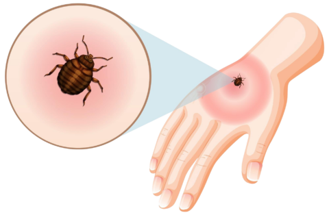 bed bug bites sting skin